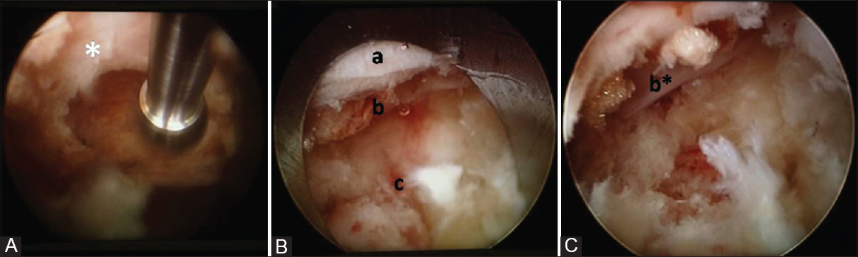 Endoscopic view: (A) Visualized foraminoplasty with Nouvag burr. (B) Discal decompression [c] with just visible traversing nerve root [b] with compressing ligament flavum [a] (C) after removal of ligamentum flavum optimally the decompressed nerve root is more visible [b*] and pulsatile peroperatively